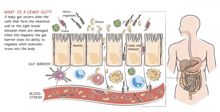 What Is A Leaky Gut And How Can It Cause So Many Health Issues?